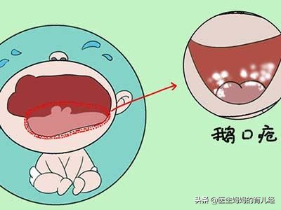 宝宝常见疾病整理？很实用、收藏！（上）