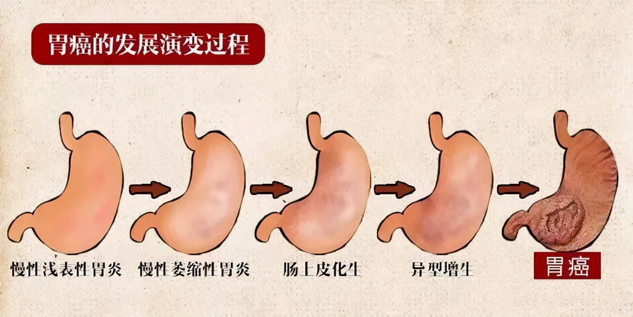 吃不下、打饱嗝，查出了这种胃炎！有人变成癌，有人能逆转，关键在于早发现、早干预