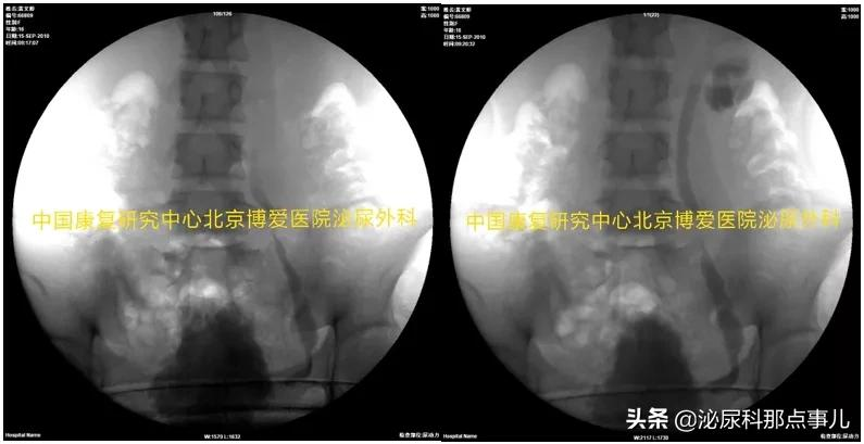 肠道膀胱扩大典型病例解析 | 神经源性下尿路功能障碍专栏 027