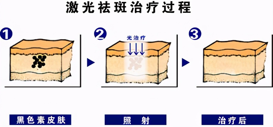 激光祛斑后色素沉着的注意事项