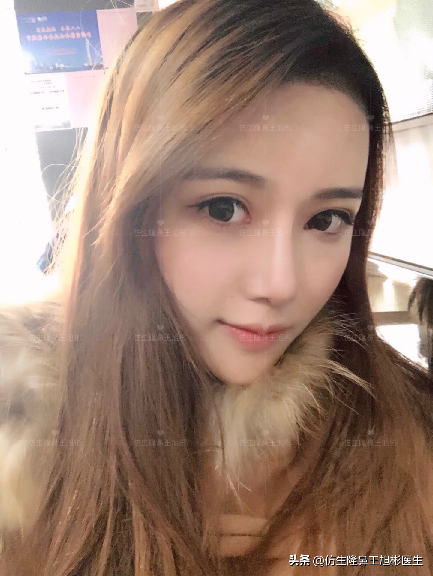 隆鼻方法那么多，你到底适合哪一种？