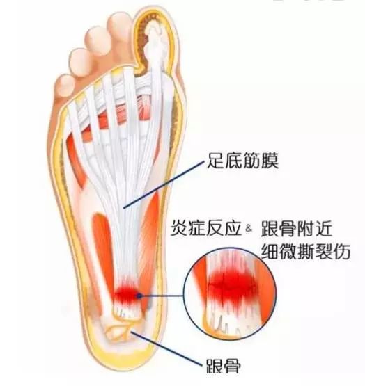 跟腱及足跟疼痛的全面缓解方法