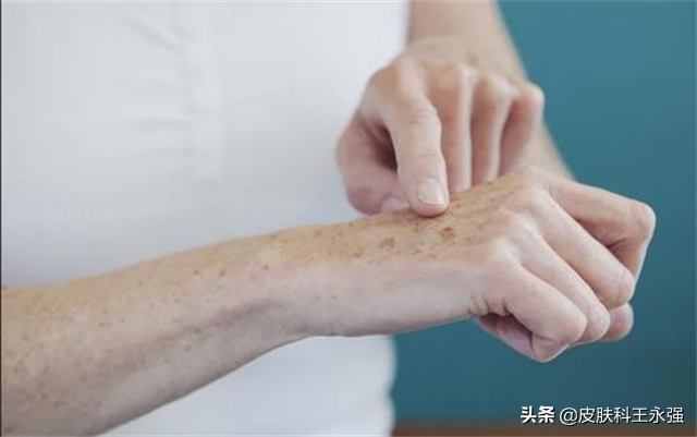 如何有效去除老年斑？实用方法大揭秘