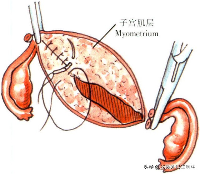 女人切除子宮，对性生活有什么影响呢？