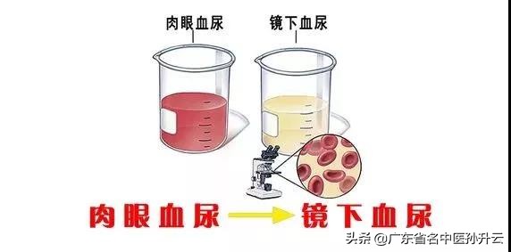 出现血尿怎么回事？尿色正常也可能有血尿？