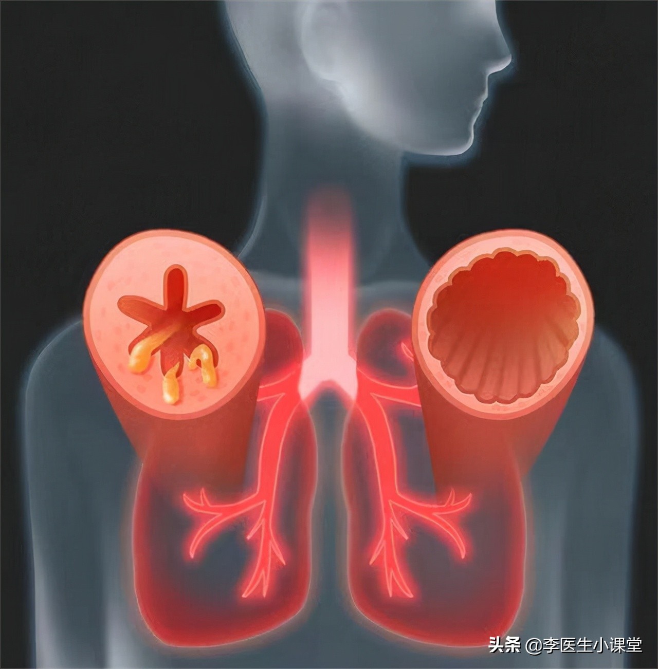 布洛芬能治疗腰腿疼、关节疼吗？哪些人不能吃？