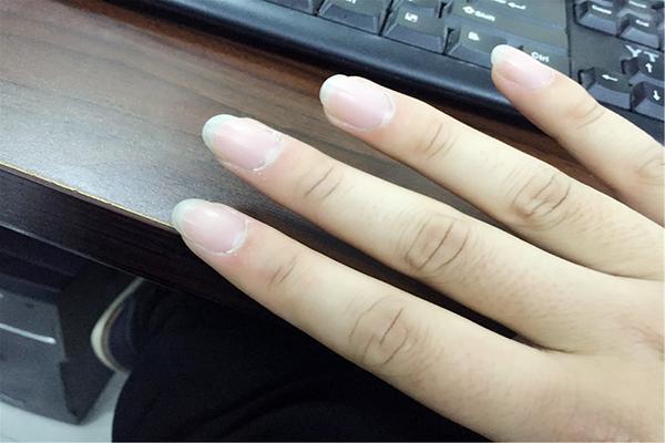 指甲上有凹沟，暗示什么病？