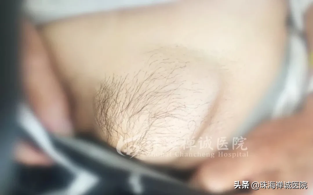 转给爸妈:发现疝气要重视,及时治疗不能拖