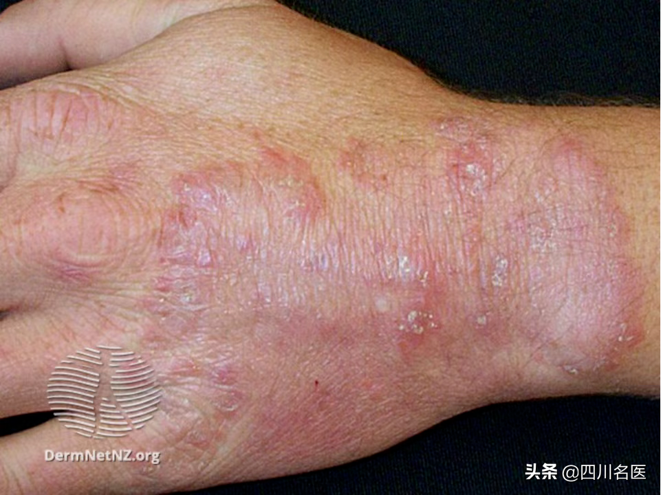 手足水泡型疱疹图片(一到夏天) - 赤虎壹号