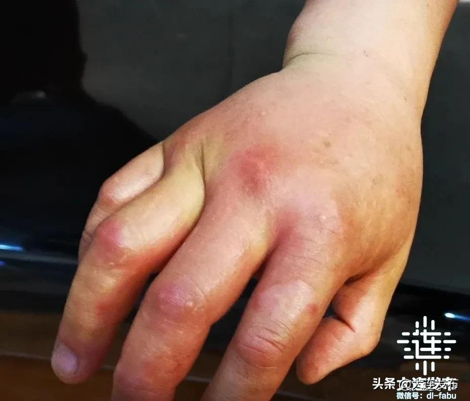 夏季虫咬皮炎患者增多