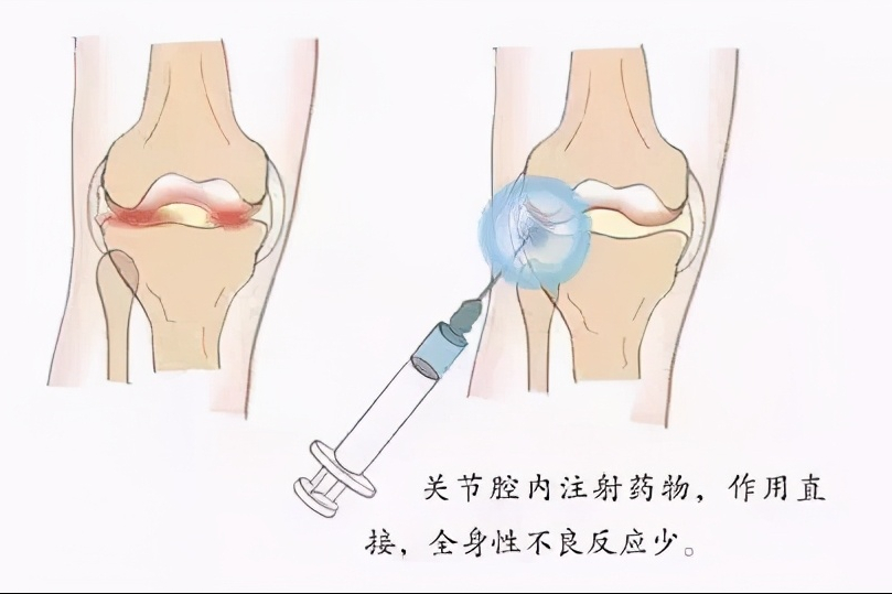 膝骨关节炎打玻璃酸钠管用吗？医生告诉你正确的使用方法
