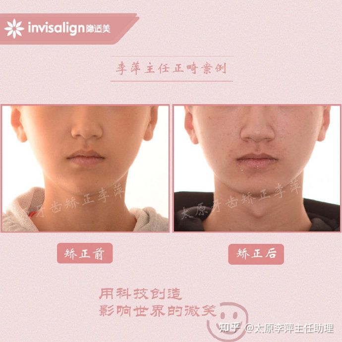 太原牙齿矫正：隐形牙套效果好不好？看这些病例你就知道了