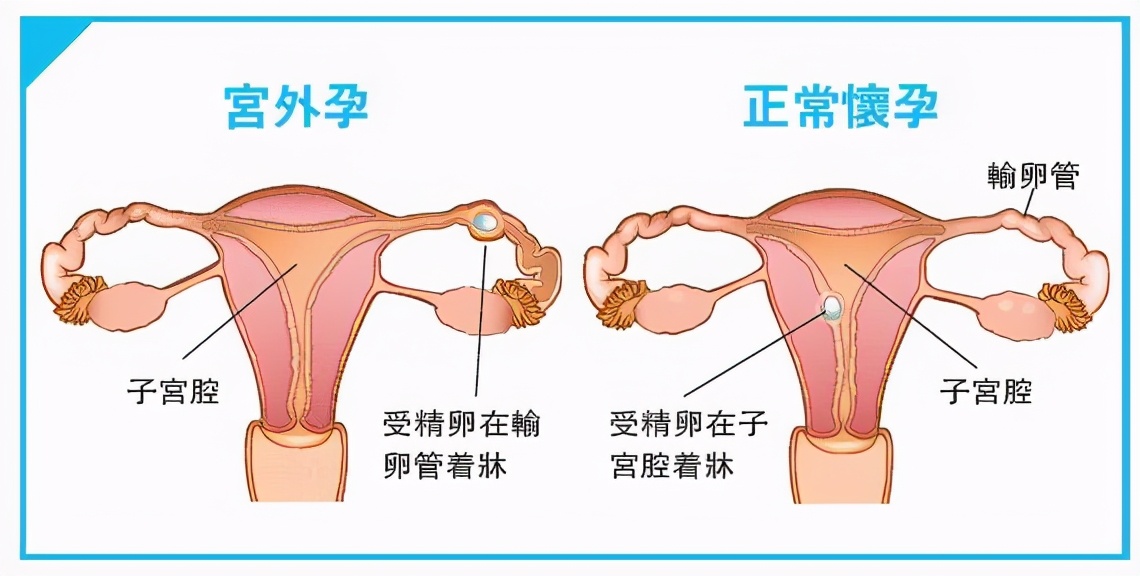 和卵子结合形成受精卵,受精卵再种植又叫着床到子宫内膜上生长发育,称