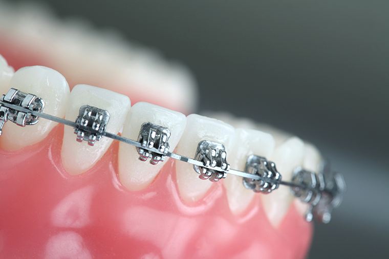 有假牙还可以进行矫正吗？需要先处理假牙吗？听听牙医怎么说