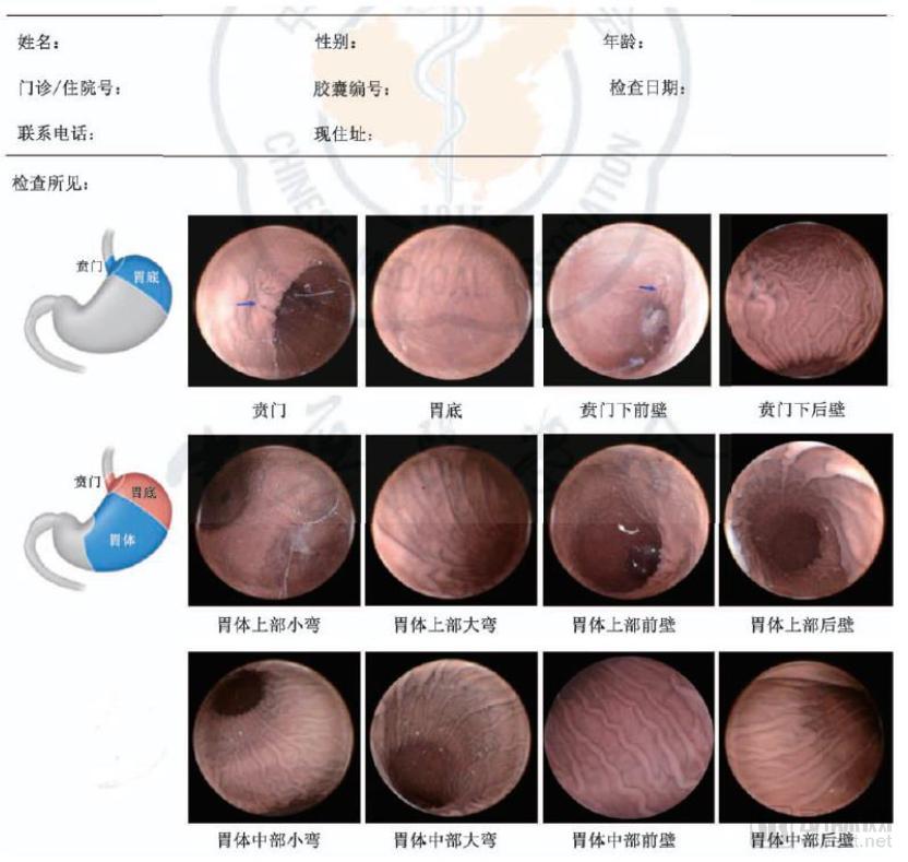 10万胶囊胃镜数据透视中国消化道健康状况，探讨器械智能化价值