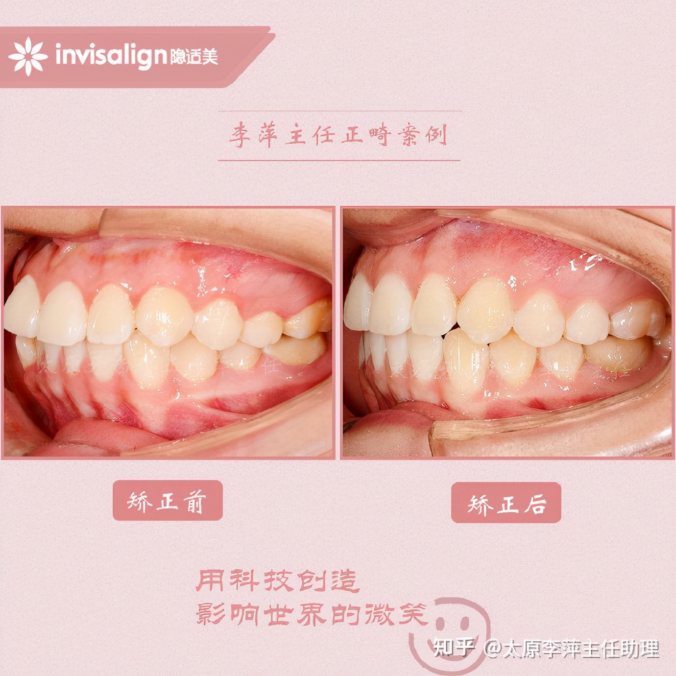 太原牙齿矫正：隐形牙套效果好不好？看这些病例你就知道了