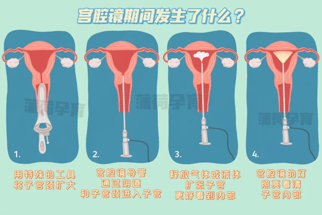 试管必备的检查之一:宫腔镜详解
