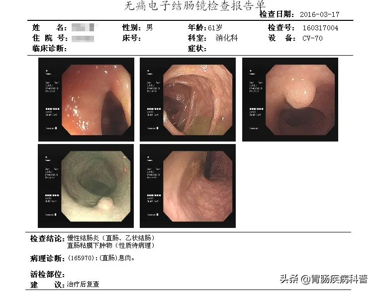 1厘米的肠息肉，6年熬成直肠癌！年过40，肠镜要做，息肉要切