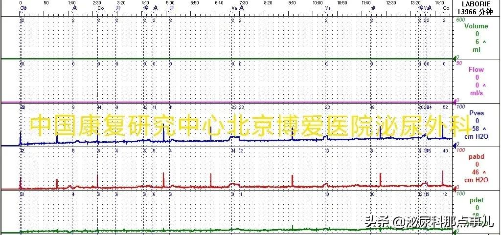 肠道膀胱扩大典型病例解析 | 神经源性下尿路功能障碍专栏 027