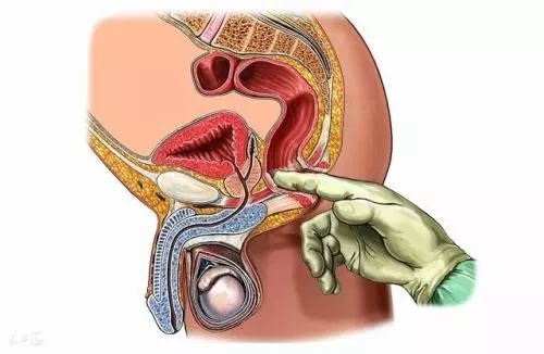 很多人抗拒做肛門指診,但這是最經濟有效的肛門直腸疾病篩查方式