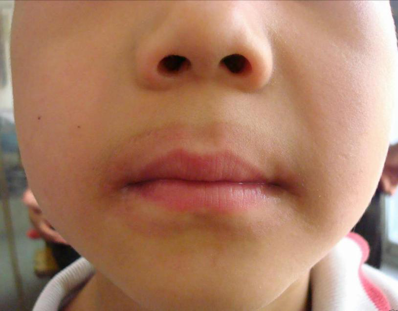 儿童口周出现淡淡的黑圈,干燥红斑,皲裂和脱屑,可能是舌舔皮炎