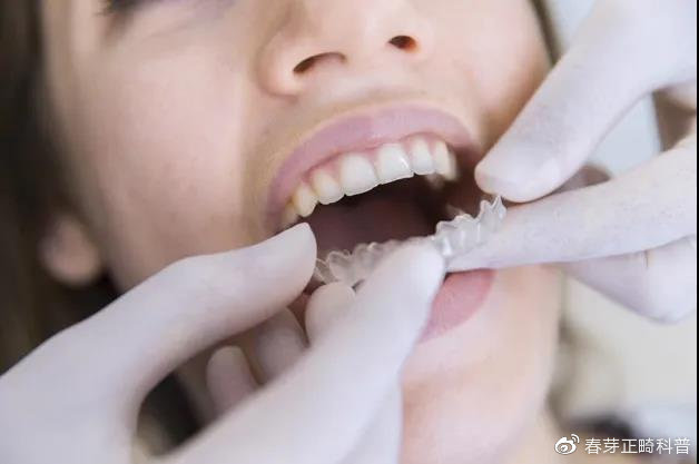 牙齿矫正收费揭秘 | 为什么有的人矫正牙齿8000，有的却是30000？