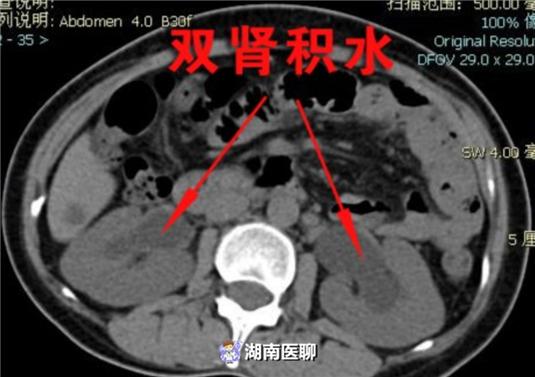 外阴小包块迅速增大成囊肿该如何处理