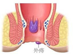 痔疮有3型4期，快来对照下，你是哪一型，哪一期？