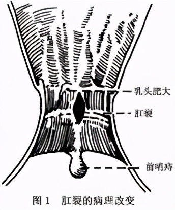 肛门解剖结构图片(菊花残) - 赤虎壹号