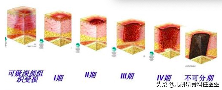 骨折后打石膏，骨科医生告诉您应该注意哪些问题