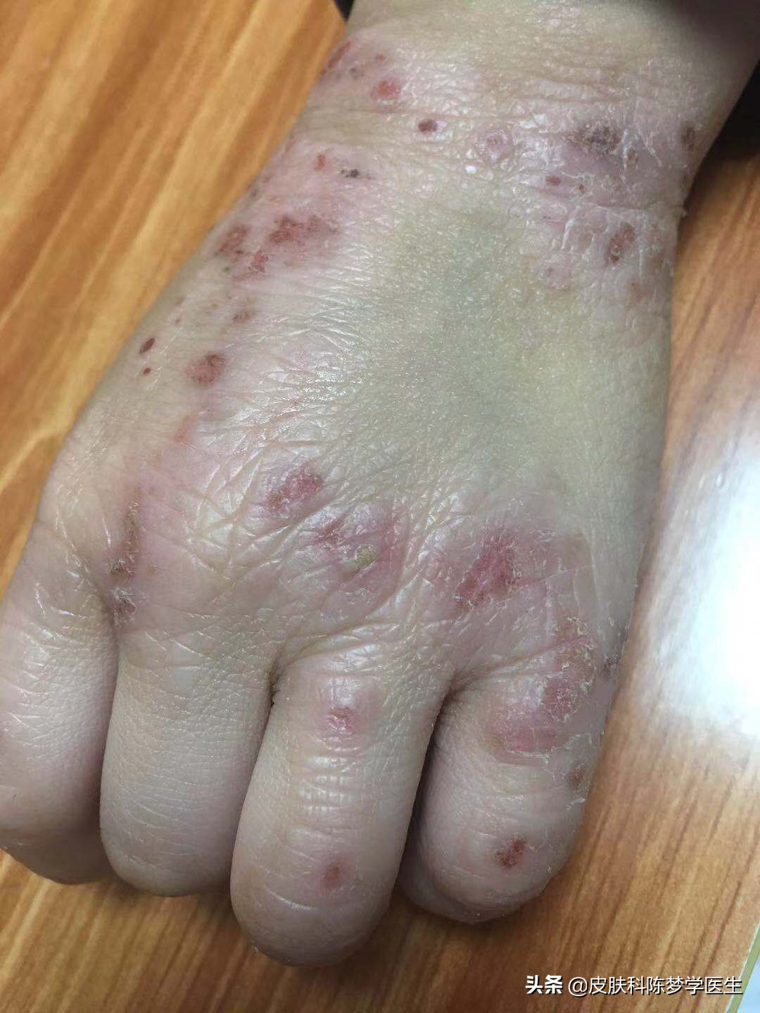 湿疹性皮炎图片(湿疹) - 赤虎壹号