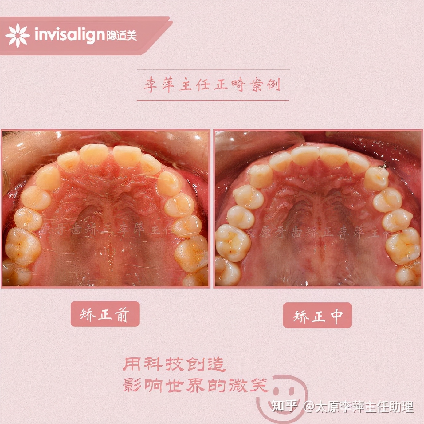 太原牙齿矫正：隐形牙套效果好不好？看这些病例你就知道了