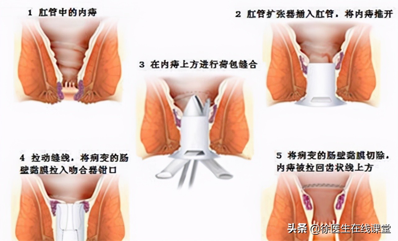 肛门边的肉球，除了痔疮，还可能是什么，需要治疗吗？
