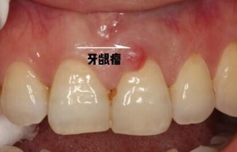 牙龈癌早期 早期症状图片
