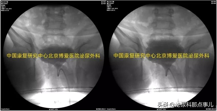 肠道膀胱扩大典型病例解析 | 神经源性下尿路功能障碍专栏 027