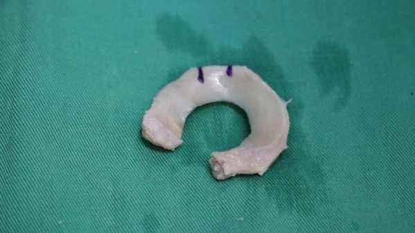 人工半月板手术价格表(什么是半月板撕裂) - 价格百科