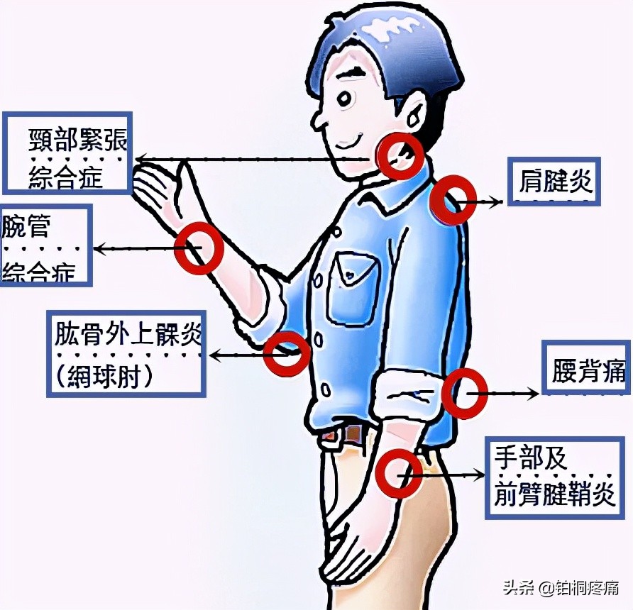 肌肉酸痛不重视，小心患上这种病……