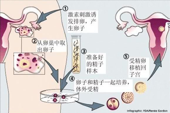 结扎后做试管婴儿成功率高吗（关于试管婴儿）