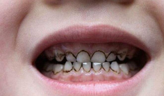 宝宝的乳牙变黑,刷牙也刷不掉,是什么原因呢?