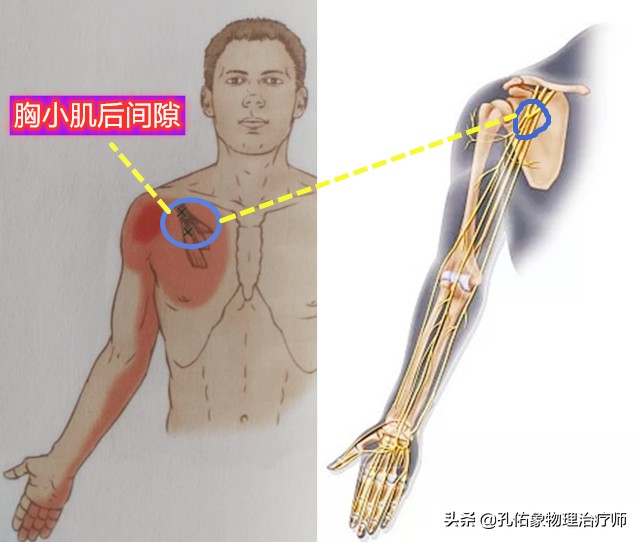 右後背疼痛是怎麼回事(肩膀疼痛是咋回事)