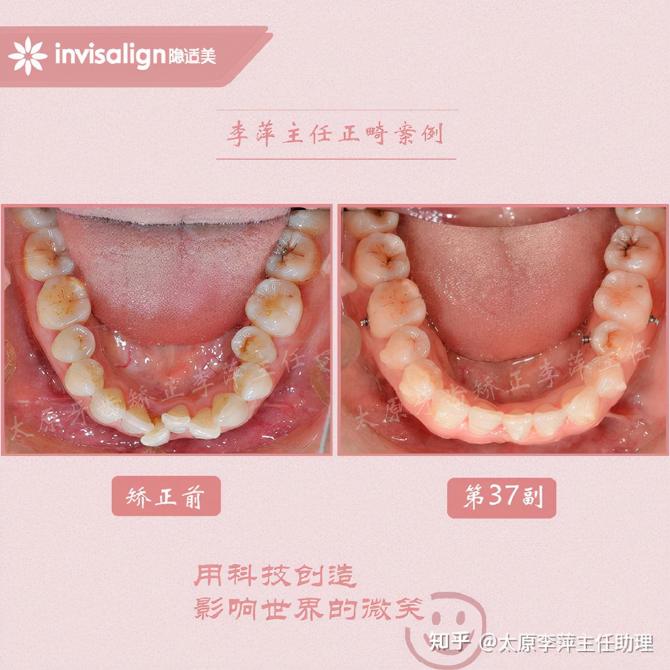 太原牙齿矫正：隐形牙套效果好不好？看这些病例你就知道了