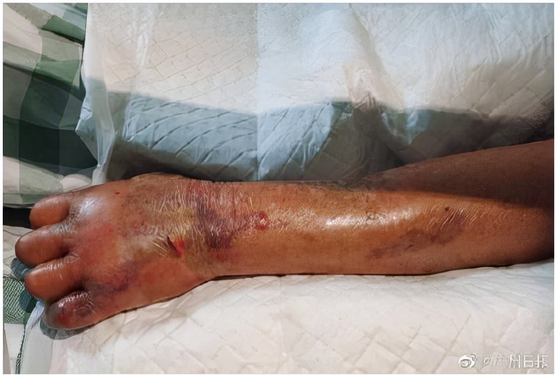 食肉菌有多恐怖,侵蚀人体器官,身体逐渐腐臭,最多24小时夺人命