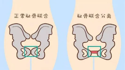耻骨的位置图详解，孕晚期为什么会耻骨痛？