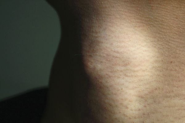 脖子和腋下长出的小肉粒,不痛也不痒,是啥东西?该怎么处理?