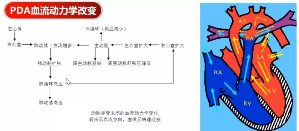 一例先心病合并重度肺动脉高压患者行剖宫产术的麻醉