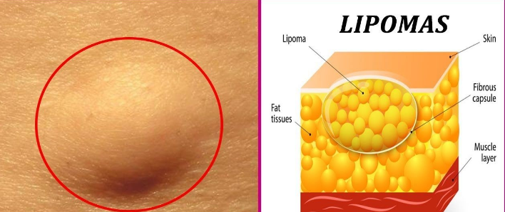 脂肪瘤会不会癌变?一文说清如何预防脂肪瘤