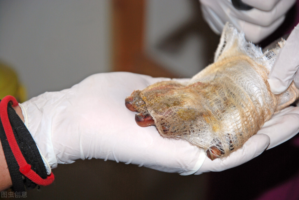 涂牙膏、抹猪油、敷蛋清、铺面粉？你真的知道怎样处理烧烫伤吗？