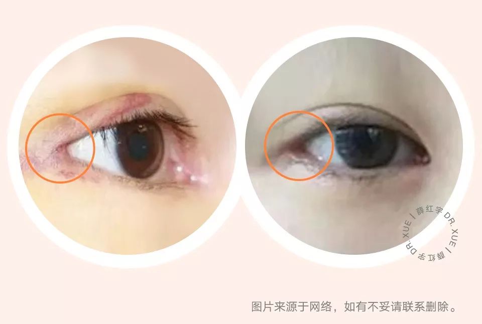 要不要开外眼角？要不要做眼睑下至？