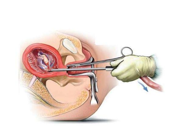 常见的流产方式，一个比一个残忍，关键是后遗症伤身体！