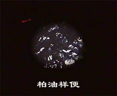 辟谣！大便发黑，一定是胃癌吗？医生说首先要排除两种情况